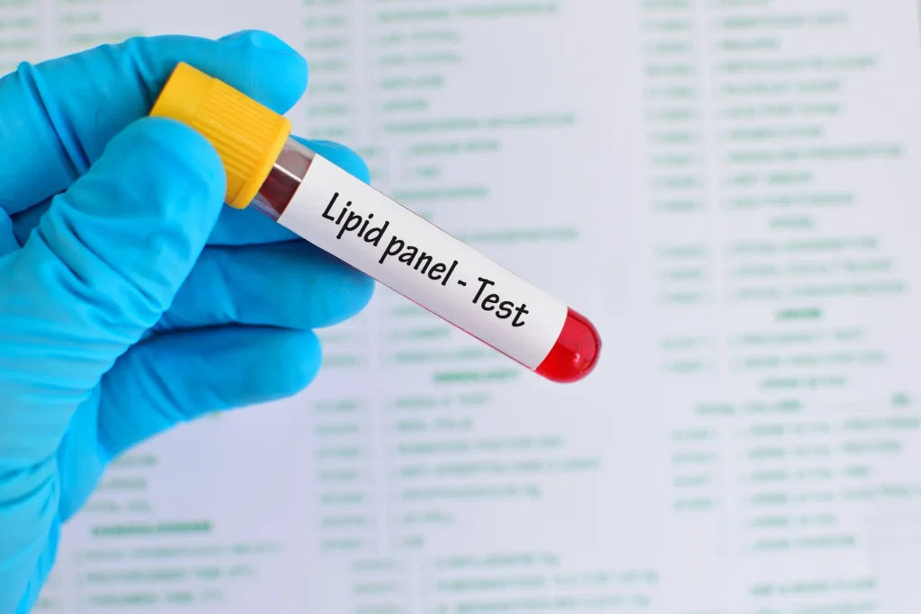 ¿Qué es un perfil lipídico y cuándo debe realizarse?